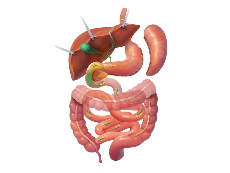 >Sleeve Gastrectomy
