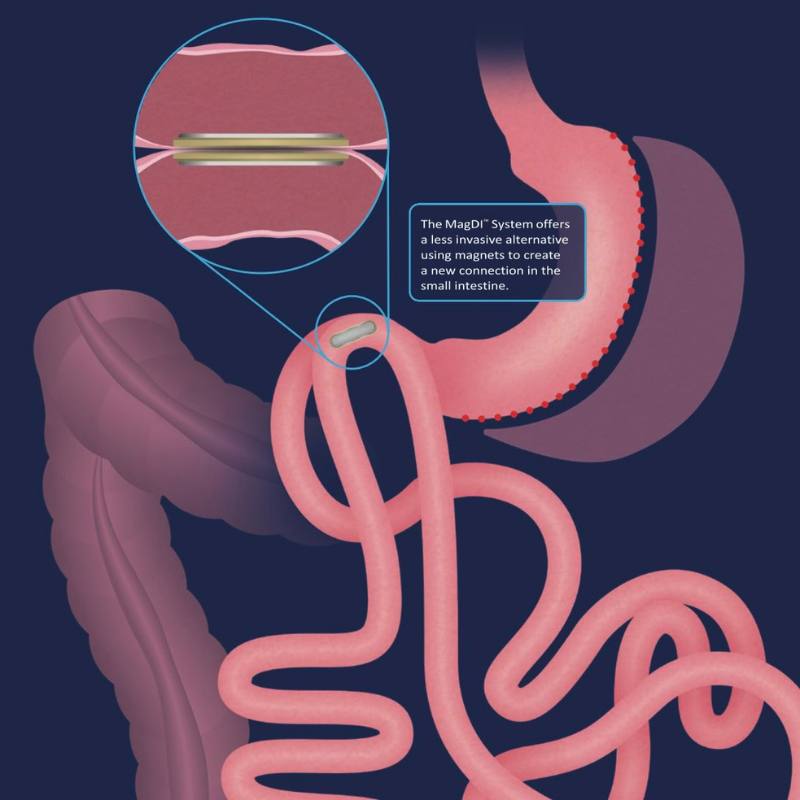 >Our Experience with Magnetic Anastomosis
